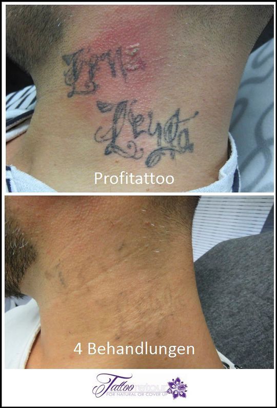 Referenzen von Tattooretour - Tattooentfernung, Cover up und Permanent Make-up-Entfernung vom Profi in Oberhausen