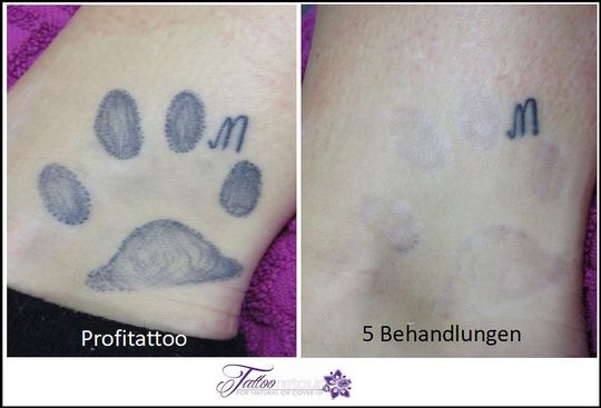 Referenzen von Tattooretour - Tattooentfernung, Cover up und Permanent Make-up-Entfernung vom Profi in Oberhausen