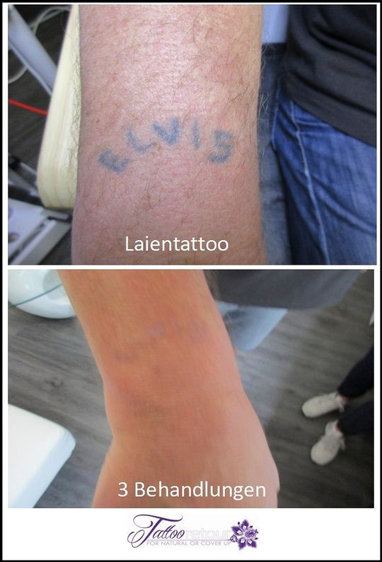 Referenzen von Tattooretour - Tattooentfernung, Cover up und Permanent Make-up-Entfernung vom Profi in Oberhausen