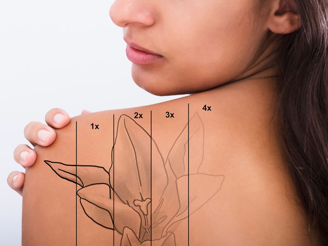 Leistungen von Tattooretour - Tattooentfernung, Cover up und Permanent Make-up-Entfernung vom Profi in Oberhausen