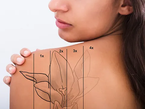 Leistungen von Tattooretour - Tattooentfernung, Cover up und Permanent Make-up-Entfernung vom Profi in Oberhausen