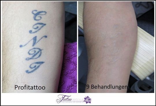 Referenzen von Tattooretour - Tattooentfernung, Cover up und Permanent Make-up-Entfernung vom Profi in Oberhausen