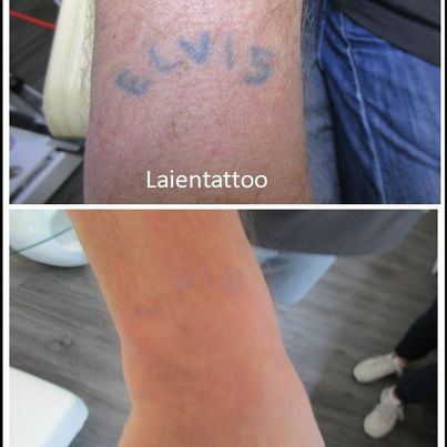 Referenzen von Tattooretour - Tattooentfernung, Cover up und Permanent Make-up-Entfernung vom Profi in Oberhausen