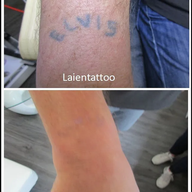 Referenzen von Tattooretour - Tattooentfernung, Cover up und Permanent Make-up-Entfernung vom Profi in Oberhausen