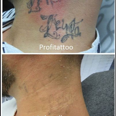 Referenzen von Tattooretour - Tattooentfernung, Cover up und Permanent Make-up-Entfernung vom Profi in Oberhausen