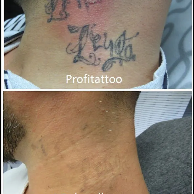 Referenzen von Tattooretour - Tattooentfernung, Cover up und Permanent Make-up-Entfernung vom Profi in Oberhausen