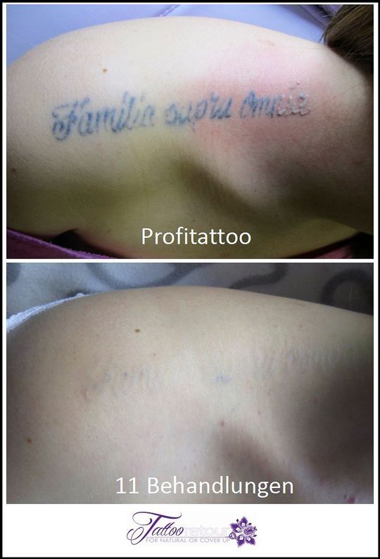 Referenzen von Tattooretour - Tattooentfernung, Cover up und Permanent Make-up-Entfernung vom Profi in Oberhausen