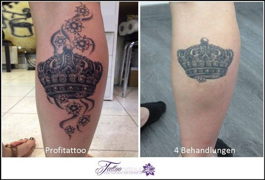 Referenzen von Tattooretour - Tattooentfernung, Cover up und Permanent Make-up-Entfernung vom Profi in Oberhausen