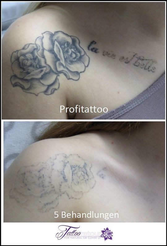 Referenzen von Tattooretour - Tattooentfernung, Cover up und Permanent Make-up-Entfernung vom Profi in Oberhausen