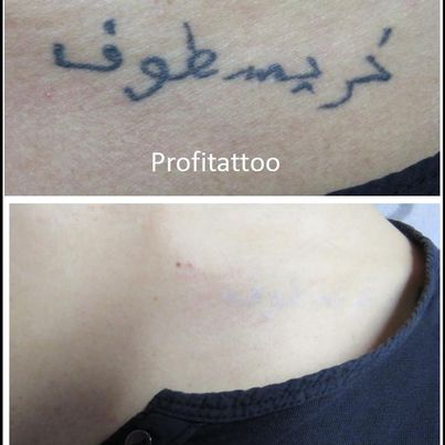 Referenzen von Tattooretour - Tattooentfernung, Cover up und Permanent Make-up-Entfernung vom Profi in Oberhausen