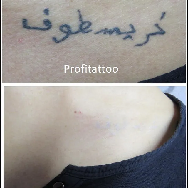 Referenzen von Tattooretour - Tattooentfernung, Cover up und Permanent Make-up-Entfernung vom Profi in Oberhausen