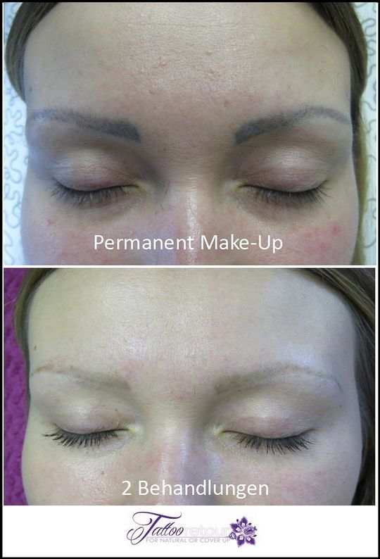 Referenzen von Tattooretour - Tattooentfernung, Cover up und Permanent Make-up-Entfernung vom Profi in Oberhausen