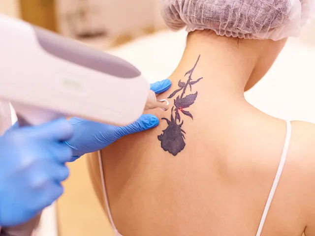 Leistungen von Tattooretour - Tattooentfernung, Cover up und Permanent Make-up-Entfernung vom Profi in Oberhausen