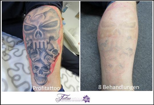 Referenzen von Tattooretour - Tattooentfernung, Cover up und Permanent Make-up-Entfernung vom Profi in Oberhausen