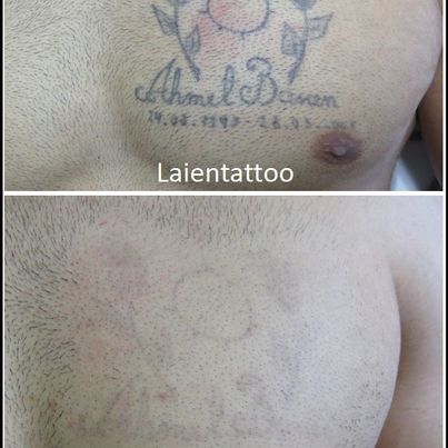 Referenzen von Tattooretour - Tattooentfernung, Cover up und Permanent Make-up-Entfernung vom Profi in Oberhausen