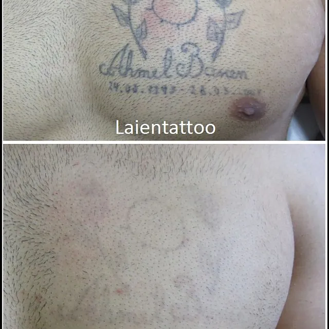 Referenzen von Tattooretour - Tattooentfernung, Cover up und Permanent Make-up-Entfernung vom Profi in Oberhausen