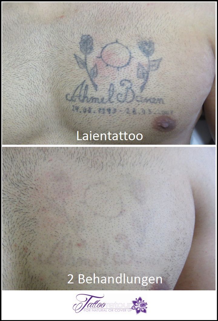 Referenzen von Tattooretour - Tattooentfernung, Cover up und Permanent Make-up-Entfernung vom Profi in Oberhausen